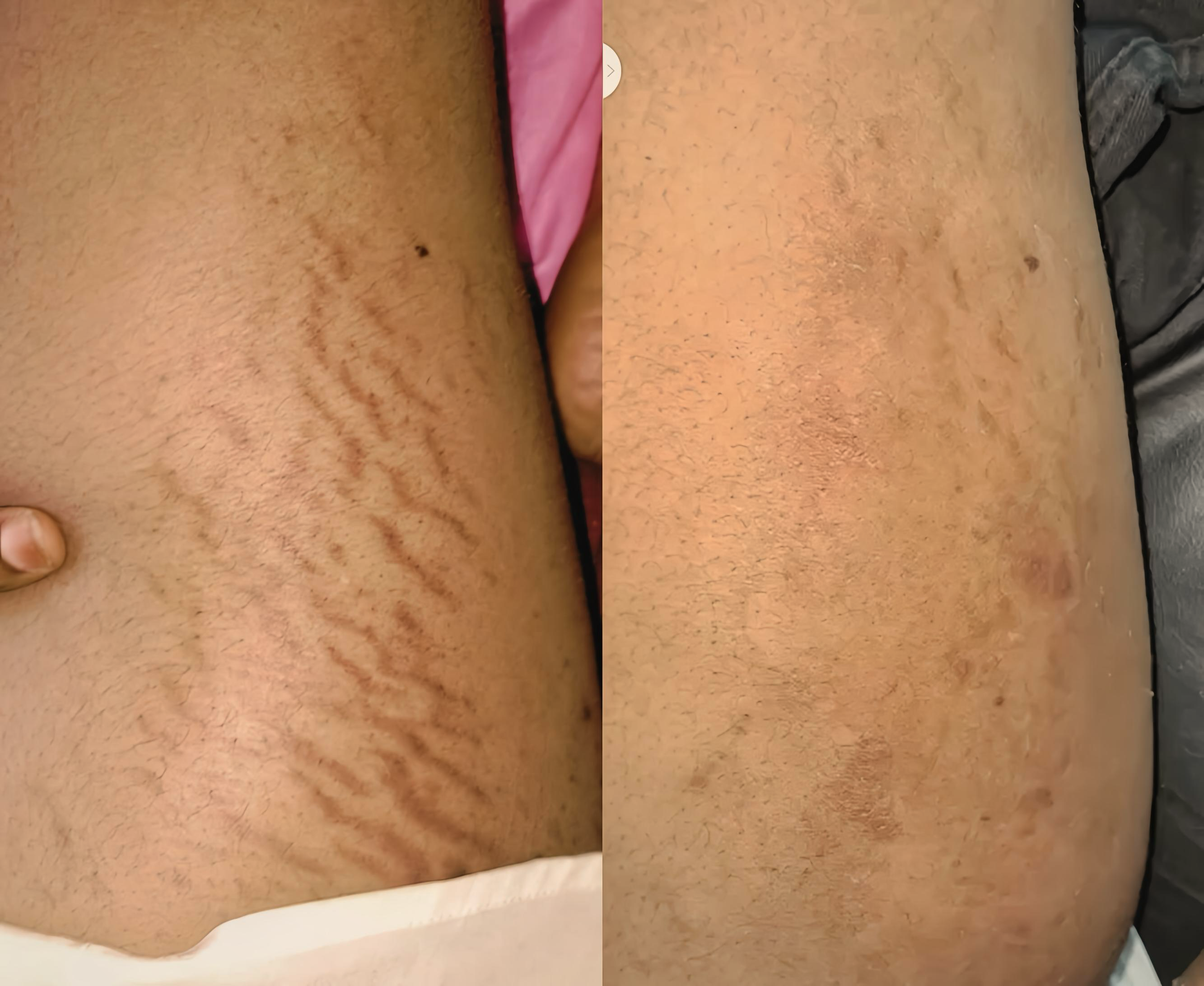 Full Stretchmarks repair kit