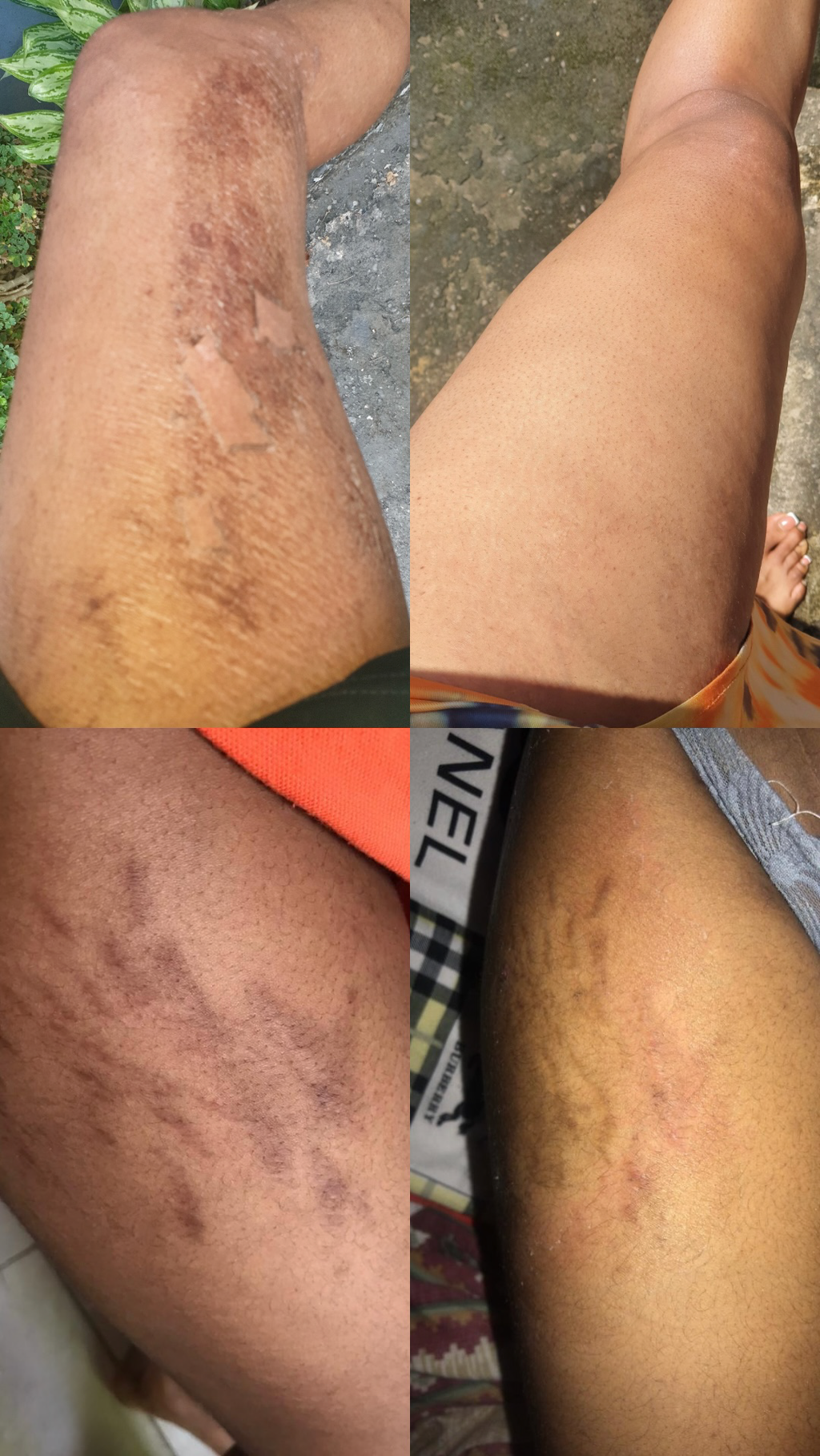 Maxi stretchmarks repair kit
